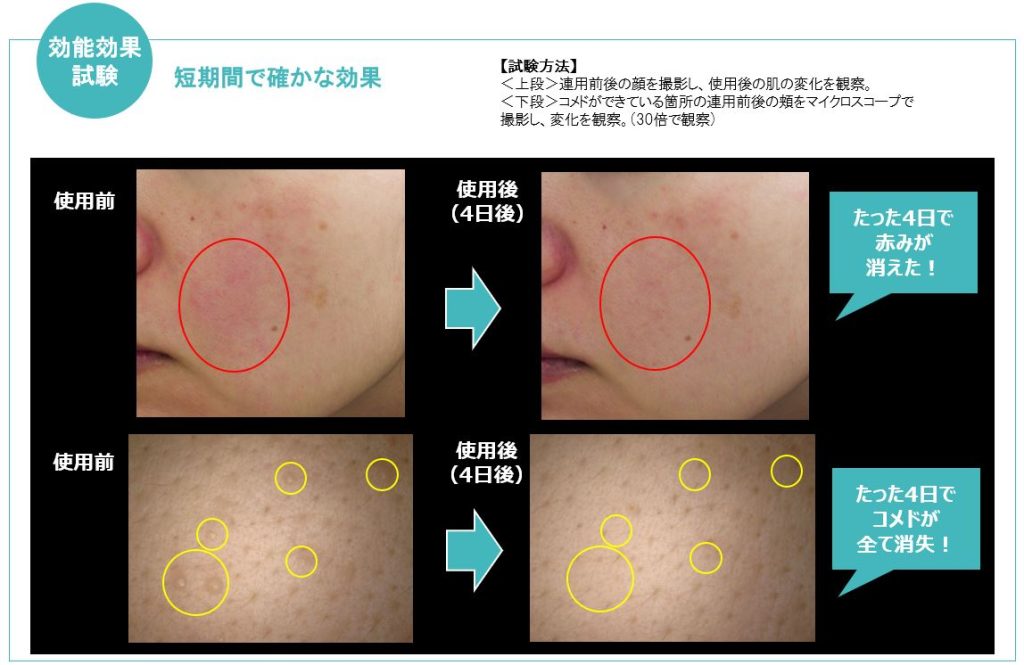 4日間で赤みとコメドを改善したデータ