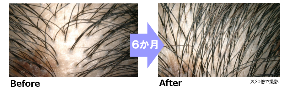 6か月後に髪が増える効果