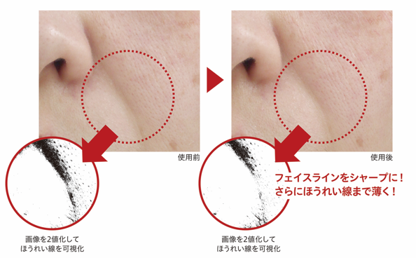 ほうれい線のリフトアップ効果